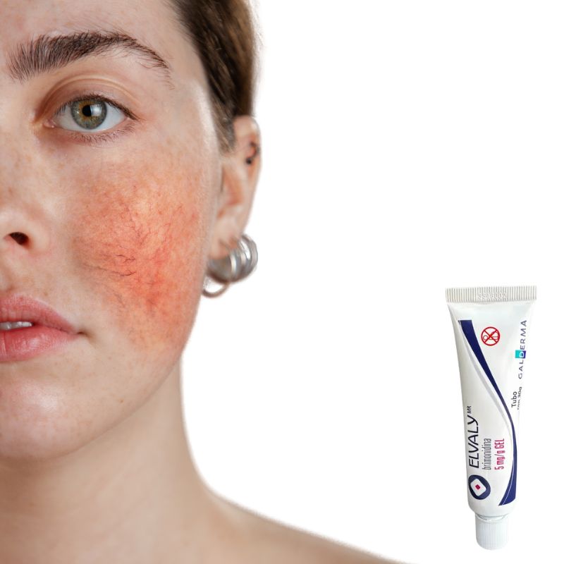 Galderma Elvaly Gel Brimonidina 5mg/g (30 ml)