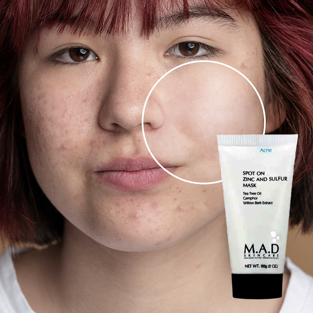 MAD ACNE MASCARILLA DE ZINC ANTI-MANCHAS (60g)
