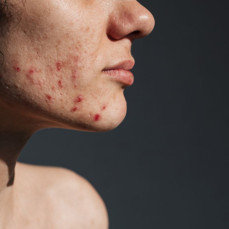 Retin-A Cream Tratamiento de acné (20 g)