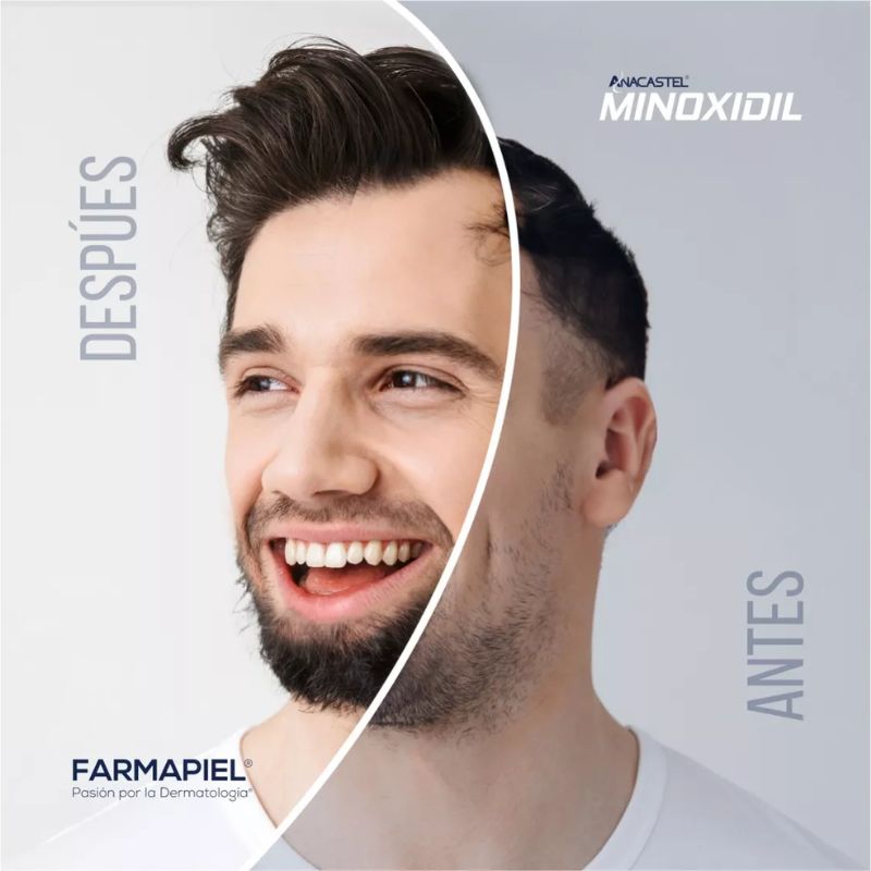 3 Piezas De Minoxidil 5% Anacastel
