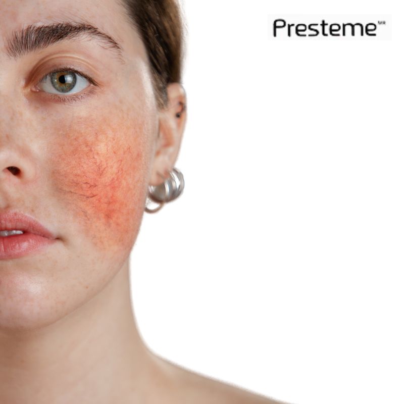 Presteme  Kit 6 Cremas De 2gr Anti Acné Rosácea